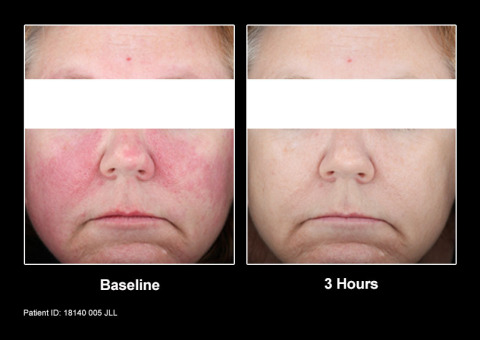 rosacea-voor-en-na-foto